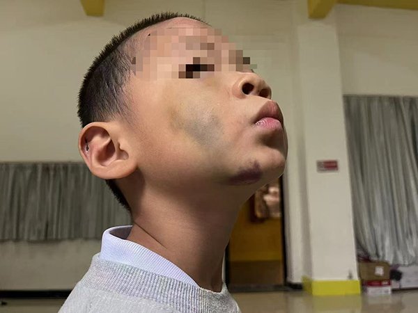 达宝优配 邵阳一男童遭虐待致轻伤二级：生父已被刑拘，检察院提前介入